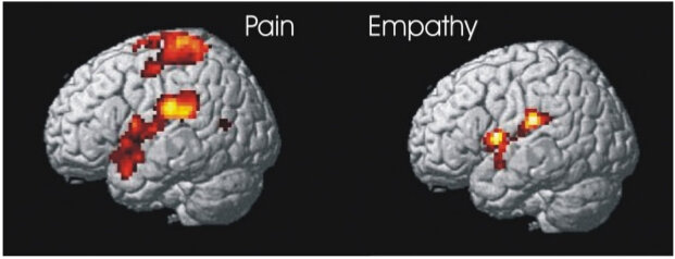 Functional brain imaging shows that some of the same regions of the brain by personal pain (left) and empathy over other’s pain (right).